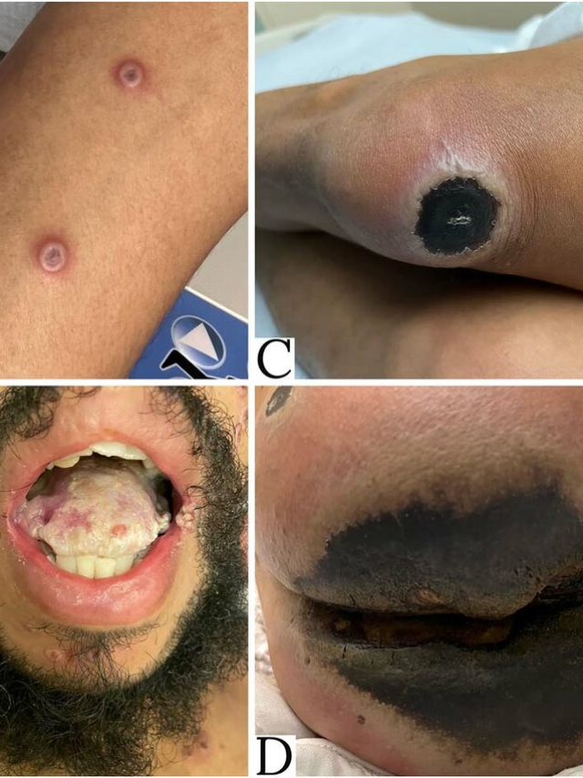 मंकी पॉक्स के क्या क्या लक्षण है? जानिए ..